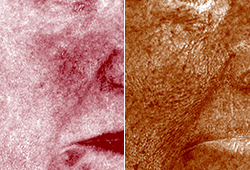Quantify Subsurface Skin Conditions